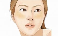 夏季怎么护理黄褐斑